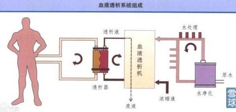 血液透析发展史 血液透析 血液透析-概述，血液透析-发展历史