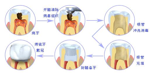 牙髓炎病因 牙髓病 牙髓病-简介，牙髓病-病因