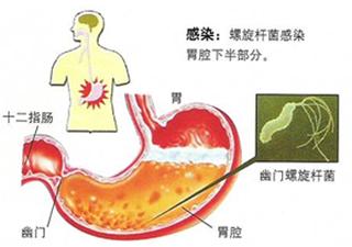 幽门螺杆菌阳性阳性870 幽门螺杆菌反复感染怎么办？