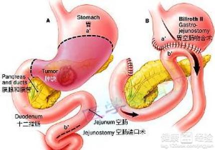 十二指肠溃疡 十二指肠球部溃疡 十二指肠球部溃疡-疾病概述，十二指肠球部溃疡