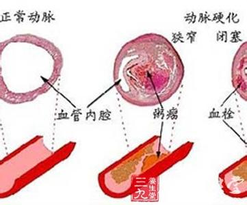 肺血栓栓塞症的概述 血栓 血栓-概述，血栓-基本概述