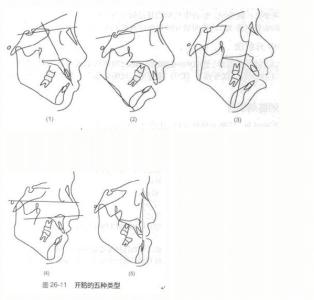 耳鸣综合诊断治疗仪 开合 开合-诊断，开合-治疗措施