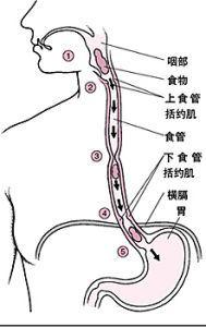 食管憩室 食管憩室 食管憩室-疾病概述，食管憩室-疾病病因