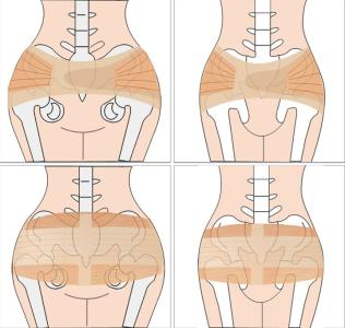 骨盆前倾怎么矫正 骨盆矫正带 骨盆矫正带-骨盆矫正带的发展，骨盆矫正带-骨盆恢复