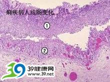 志贺氏菌 志贺菌病 志贺菌病-志贺菌病的种类，志贺菌病-志贺菌病的症状