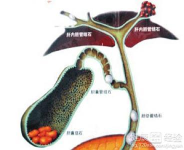 结石性胆囊炎 结石性胆囊炎 结石性胆囊炎-疾病病因，结石性胆囊炎-病理生理