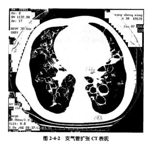 支气管扩张病因 支气管扩张症 支气管扩张症-简介，支气管扩张症-病因