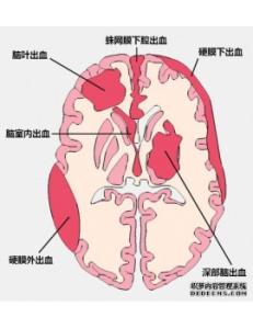 高血压脑出血临床路径 高血压脑出血 高血压脑出血-临床诊断，高血压脑出血-鉴别诊断