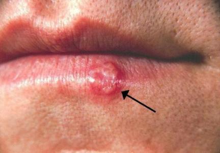 herpes simplex virus 人类疱疹病毒 人类疱疹病毒-单纯疱疹病毒（Herpessimplexvirus,