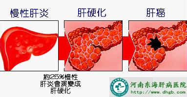 肝硬化肝功能失代偿期 肝硬化肝功能失代偿期 肝硬化肝功能失代偿期-症状，肝硬化肝功能