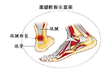 跟腱断裂 跟腱断裂 跟腱断裂-概述，跟腱断裂-分类