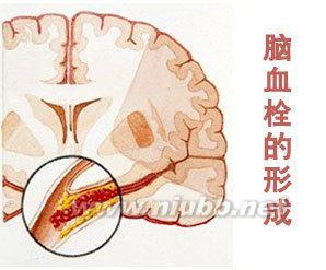 病理生理学 脑血管硬化 脑血管硬化-概述，脑血管硬化-病理生理