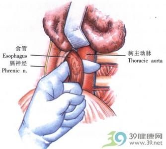 喷门癌 喷门癌 喷门癌-概述，喷门癌-预防