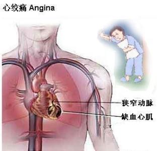 变异性心绞痛症状 变异性心绞痛 变异性心绞痛-疾病描述，变异性心绞痛-症状体征