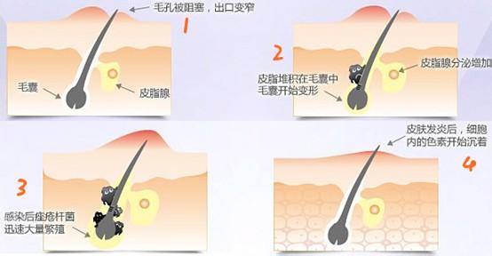 痤疮是如何形成的视频 痘痘是如何形成的