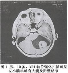 流行病学病因 星形细胞瘤 星形细胞瘤-流行病学，星形细胞瘤-病因