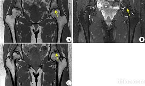 无菌性股骨头坏死 无菌性股骨头坏死 无菌性股骨头坏死-　　概述，无菌性股骨头坏死