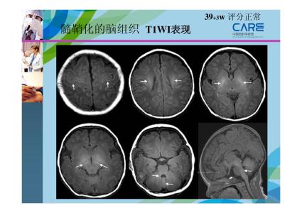 新生儿缺氧缺血性脑病 缺血缺氧性脑病 缺血缺氧性脑病-发病原因，缺血缺氧性脑病-病因