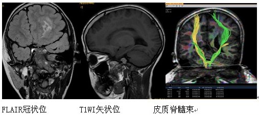 为何会得巨脑回畸形 巨脑回畸形