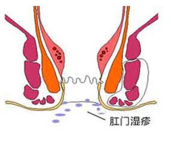 肛门湿疹的病因 肛门湿疹 肛门湿疹-概述，肛门湿疹-病因原理