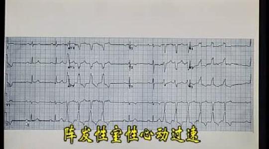 阵发性室上性心动过速 阵发性室上性心动过速 阵发性室上性心动过速-简介，阵发性室上性