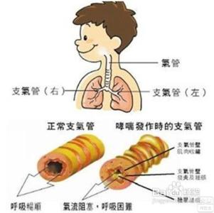 哮喘的最佳治疗方法 哮喘能治好吗