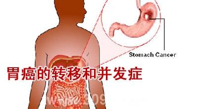 胃癌扩散 胃癌转移能治好吗