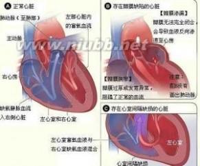 急性前列腺炎病因病理 心脏杂音 心脏杂音-简要概述，心脏杂音-病理病因