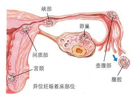 输卵管积水 原因 输卵管积水 输卵管积水-疾病概述，输卵管积水-原因