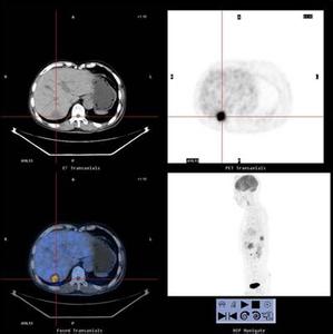 pet ct检查副作用 PET-CT PET-CT-作用，PET-CT-特点