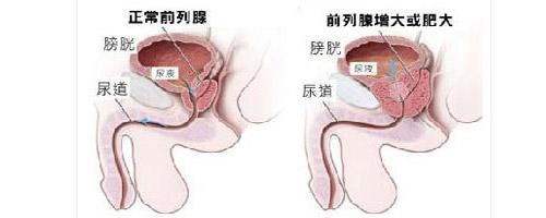 前列腺肥大发病原因 前列腺肥大 前列腺肥大-疾病常识，前列腺肥大-发病原因