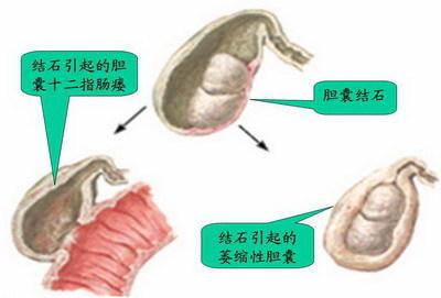 胆结石治疗要多少钱啊 胆结石怎么治疗有效