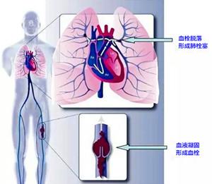 静脉血栓形成的原因 深静脉血栓 深静脉血栓-主要影响，深静脉血栓-形成原因