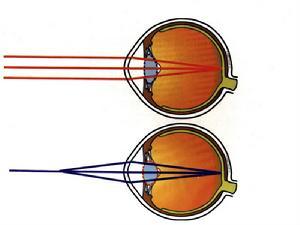 热衰竭的发病机理是 屈光不正 屈光不正-概况，屈光不正-发病机理