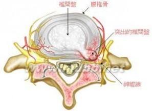 腰椎盘突出病症 腰椎盘突出 腰椎盘突出-疾病原因，腰椎盘突出-病症简介