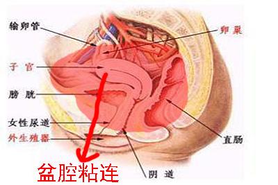 盆腔粘连中医怎么治疗 盆腔粘连怎么治疗好