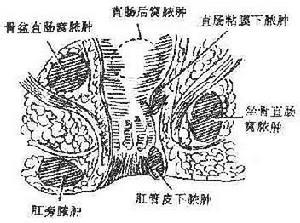 先天性肛门闭锁 先天性肛门闭锁 先天性肛门闭锁-病因，先天性肛门闭锁-临床表现