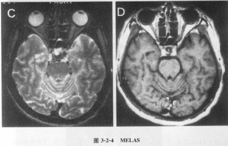 线粒体脑病影像学 线粒体脑病