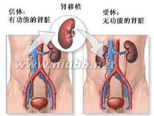 肾移植术前准备 肾移植 肾移植-必要，肾移植-准备工作