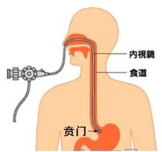 贲门松弛 贲门松弛 贲门松弛-基本内容