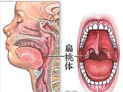 扁桃体癌的早期症状 扁桃体癌 扁桃体癌-基本内容，扁桃体癌-症状体征