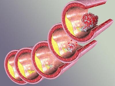 动脉粥样硬化指数4.13 动脉粥样硬化指数