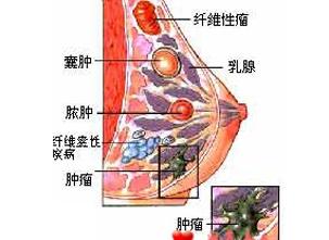 乳腺增生的病因 乳腺囊性增生病 乳腺囊性增生病-病因，乳腺囊性增生病-发病机制