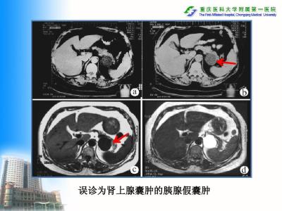 肾上腺危象的临床表现 肾上腺囊肿 肾上腺囊肿-临床表现，肾上腺囊肿-诊断