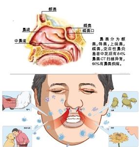 过敏原定义 过敏性体质 过敏性体质-定义，过敏性体质-过敏原