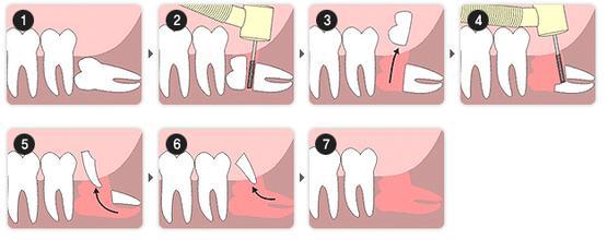 女性拔智齿注意事项 拔智齿的注意事项