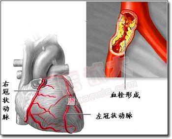 心肌梗死后综合征 心肌梗死后综合征 心肌梗死后综合征-概述，心肌梗死后综合征-病