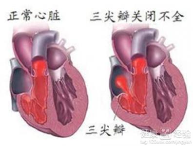 肝功能不全的临床表现 三尖瓣关闭不全 三尖瓣关闭不全-概述，三尖瓣关闭不全-临床表现