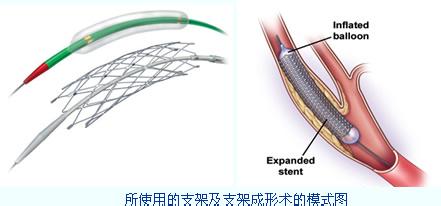 先心病介入手术优缺点 介入治疗 介入治疗-优点，介入治疗-种类