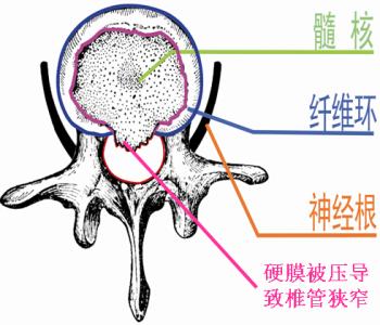 腰椎管狭窄发病原因 腰椎管狭窄 腰椎管狭窄-定义，腰椎管狭窄-发病原因